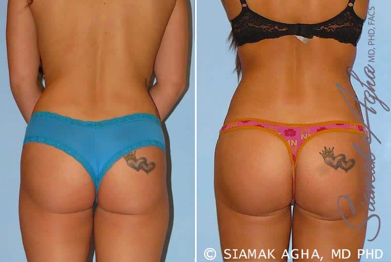 Orange County Brazilian Butt Lift Patient 12 Back Newport Beach, CA