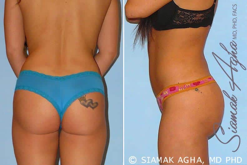 Orange County Brazilian Butt Lift Patient 12 Left Newport Beach, CA