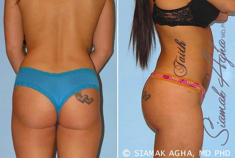 Orange County Brazilian Butt Lift Patient 12 Right Newport Beach, CA