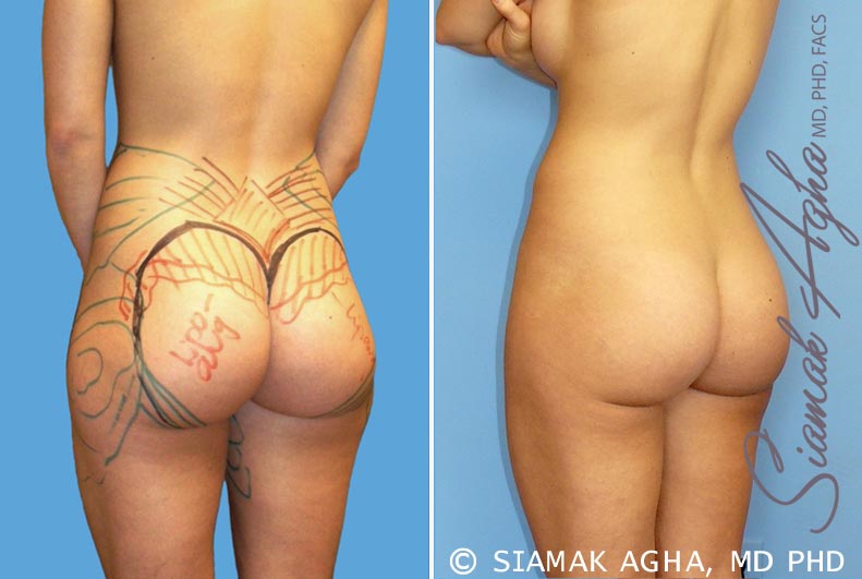 Orange County Brazilian Butt Lift Patient 14 Back Left Newport Beach, CA