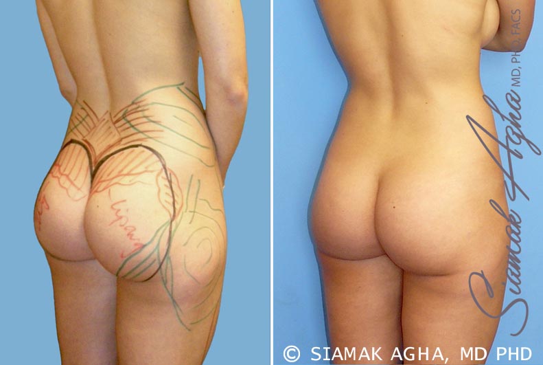 Orange County Brazilian Butt Lift Patient 14 Back Right Newport Beach, CA