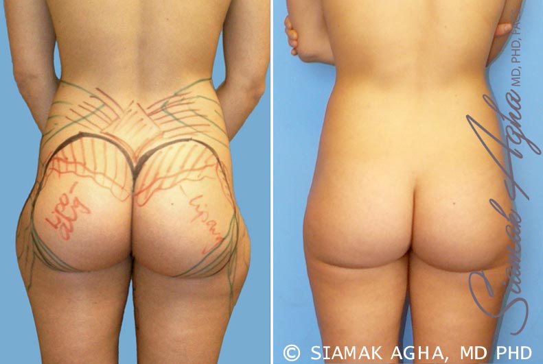 Orange County Brazilian Butt Lift Patient 14 Back Newport Beach, CA