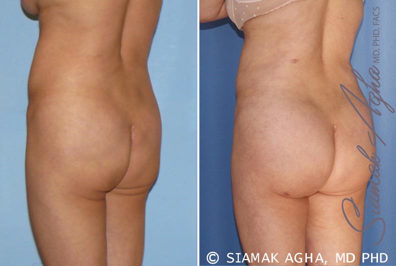 Orange County Brazilian Butt Lift Patient 15 Back Left Newport Beach, CA