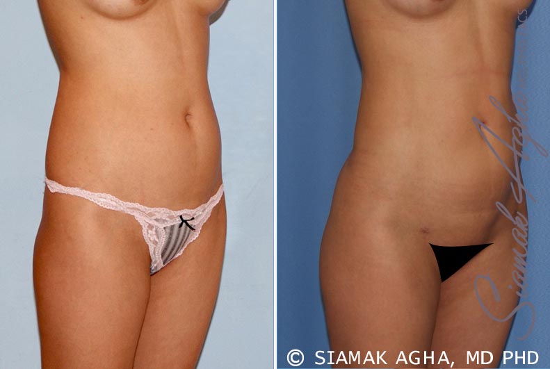 Orange County Brazilian Butt Lift Patient 17 Front Right Newport Beach, CA