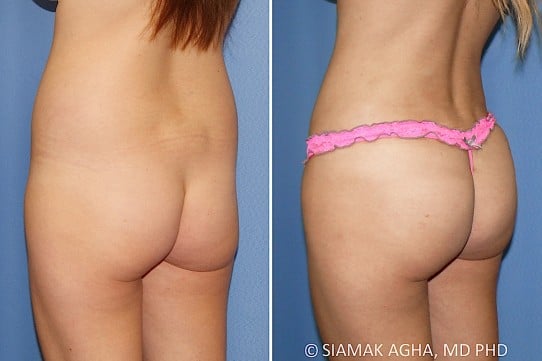 Orange County Brazilian Butt Lift Patient 341 Back Left Newport Beach, CA