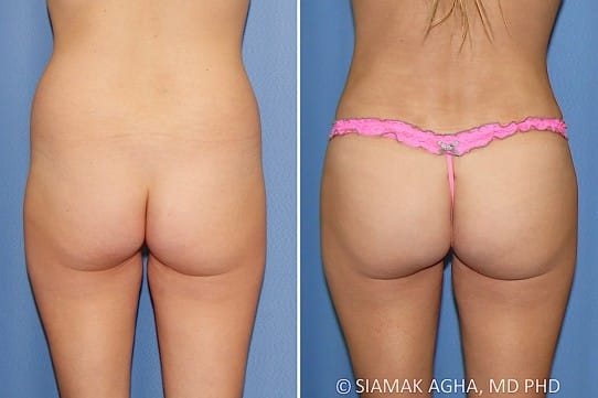 Orange County Brazilian Butt Lift Patient 341 Back Newport Beach, CA