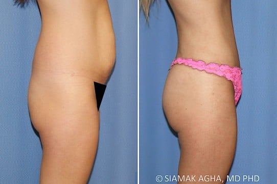 Orange County Brazilian Butt Lift Patient 341 Right Newport Beach, CA