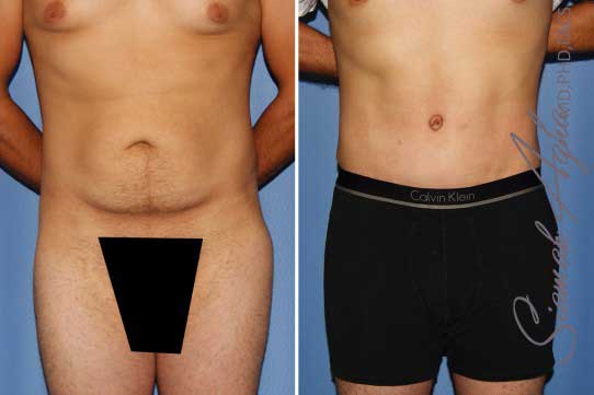 Tummy Tuck