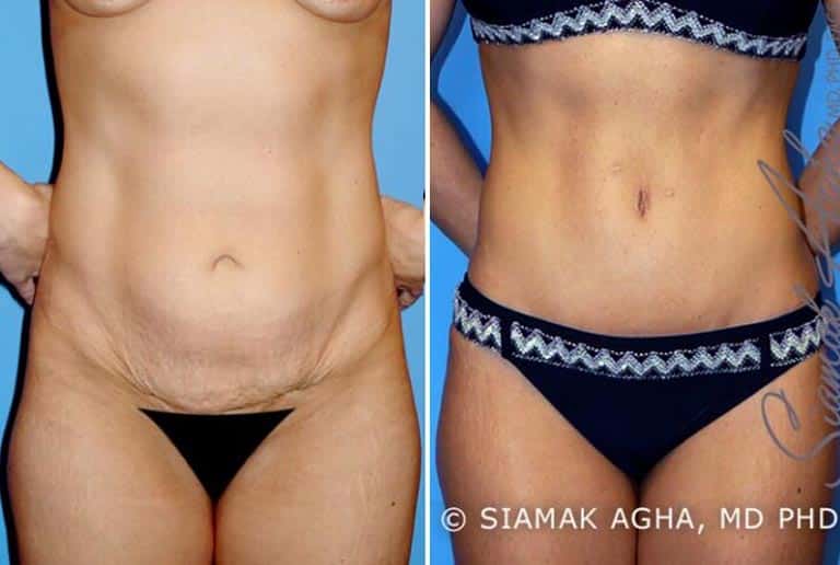 Tummy Tuck