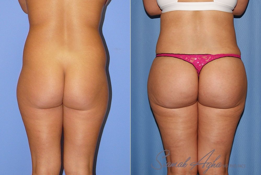 Brazilian Butt Lift Patient 71 Back Newport Beach, CA