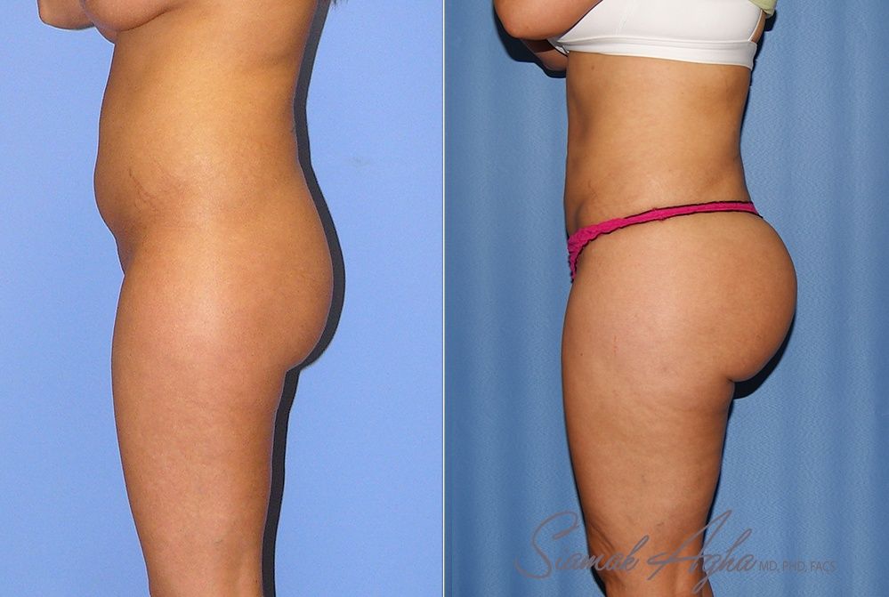 Brazilian Butt Lift Patient 71 Back Right Newport Beach, CA