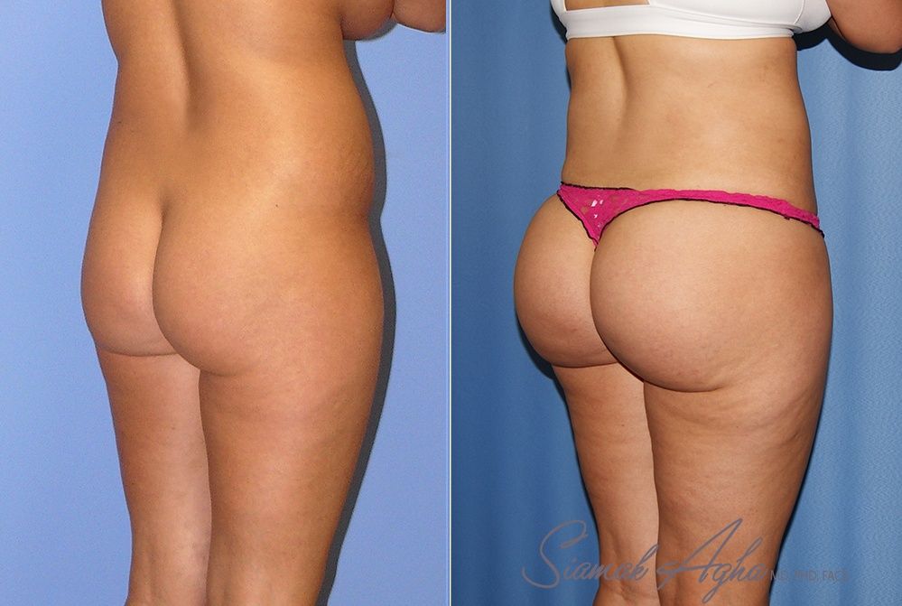 Brazilian Butt Lift Patient 71 Back Left Newport Beach, CA