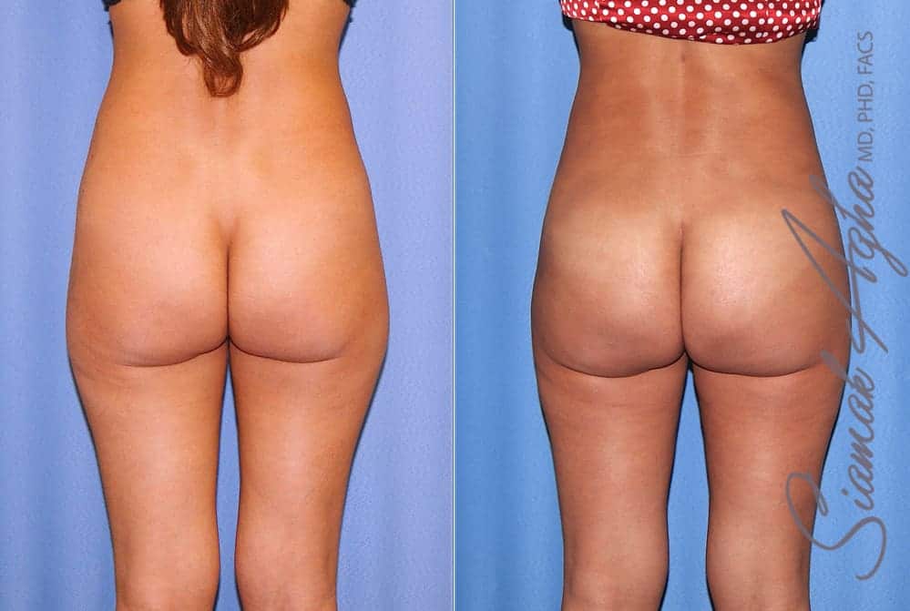 Brazilian Butt Lift Patient 72 Back Newport Beach, CA