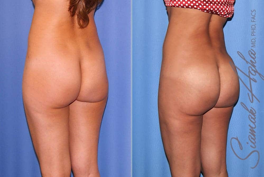 Brazilian Butt Lift Patient 72 Left Newport Beach, CA