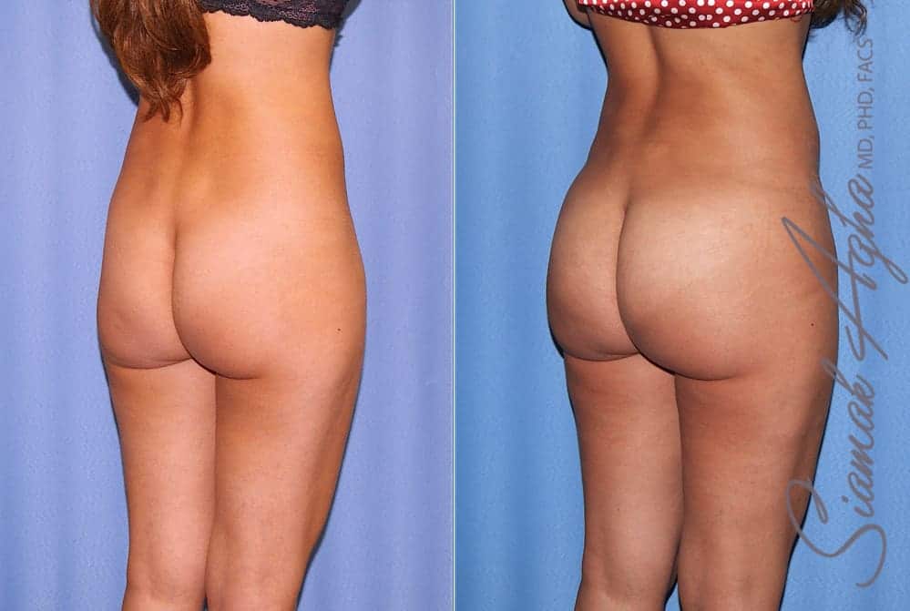 Brazilian Butt Lift Patient 72 Rigth Newport Beach, CA