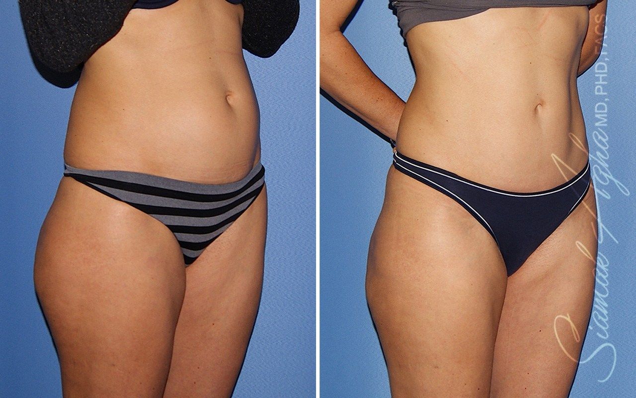 Mini Tummy Tuck