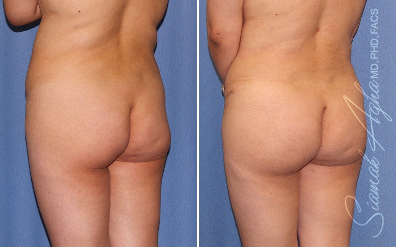 Orange County Brazilian Butt Lift Patient 42 Back Left Newport Beach, CA