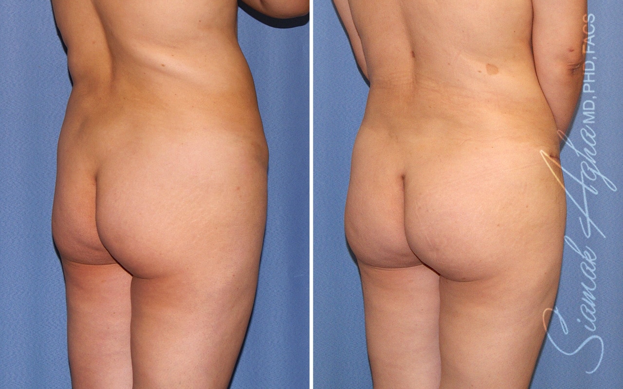 Orange County Brazilian Butt Lift Patient 42 Back Right Newport Beach, CA