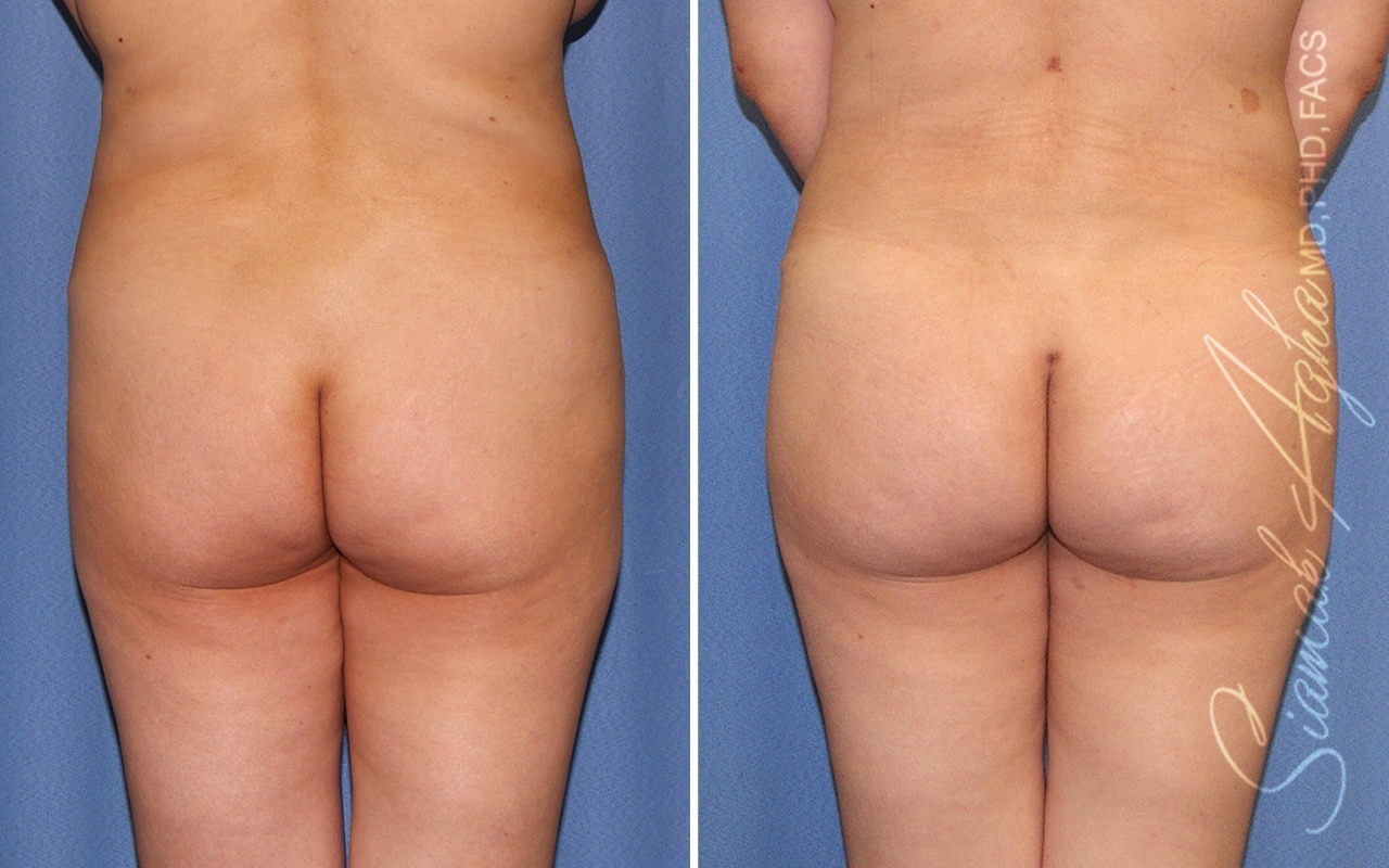 Orange County Brazilian Butt Lift Patient 42 Back Newport Beach, CA