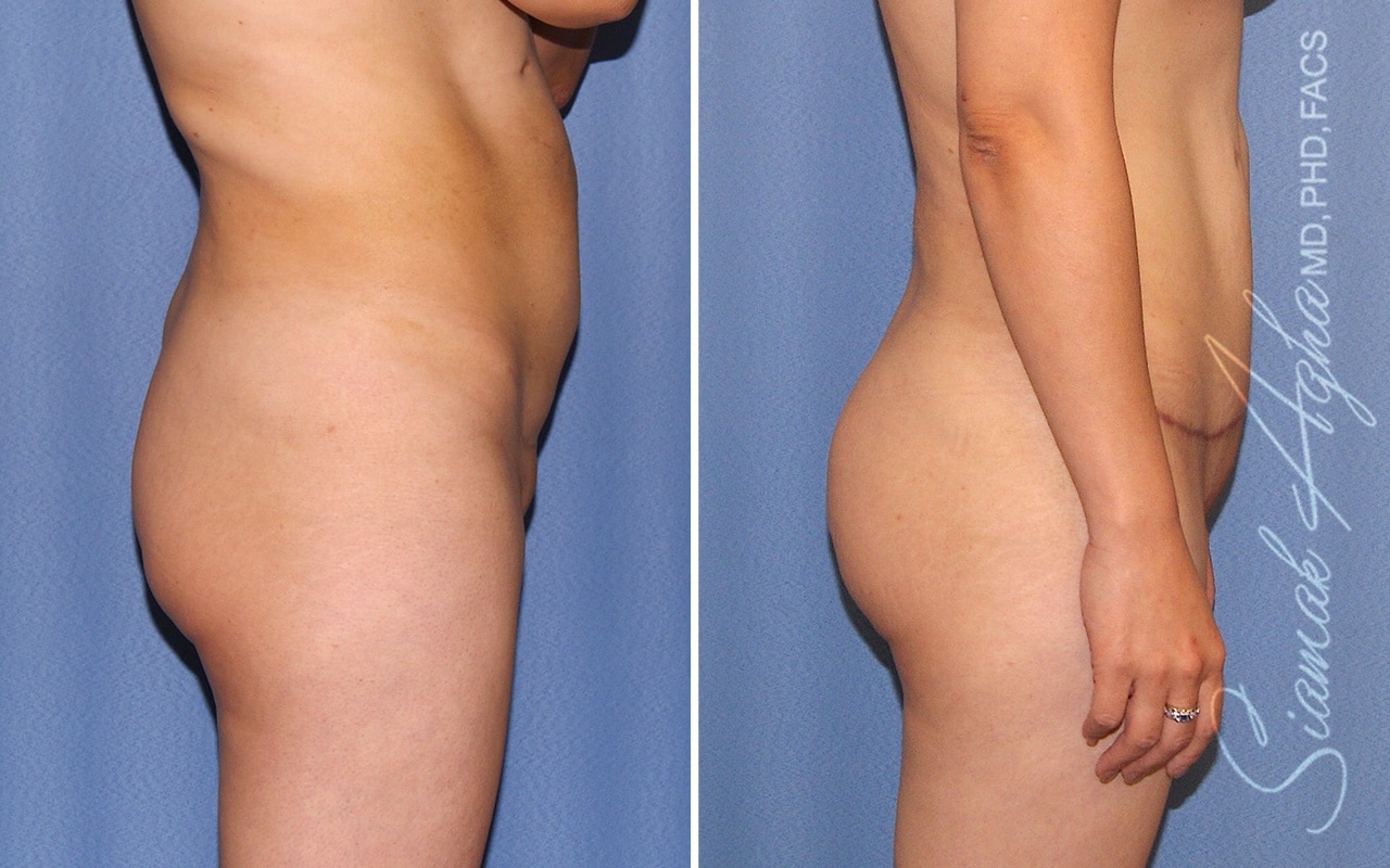 Orange County Brazilian Butt Lift Patient 42 Right Newport Beach, CA