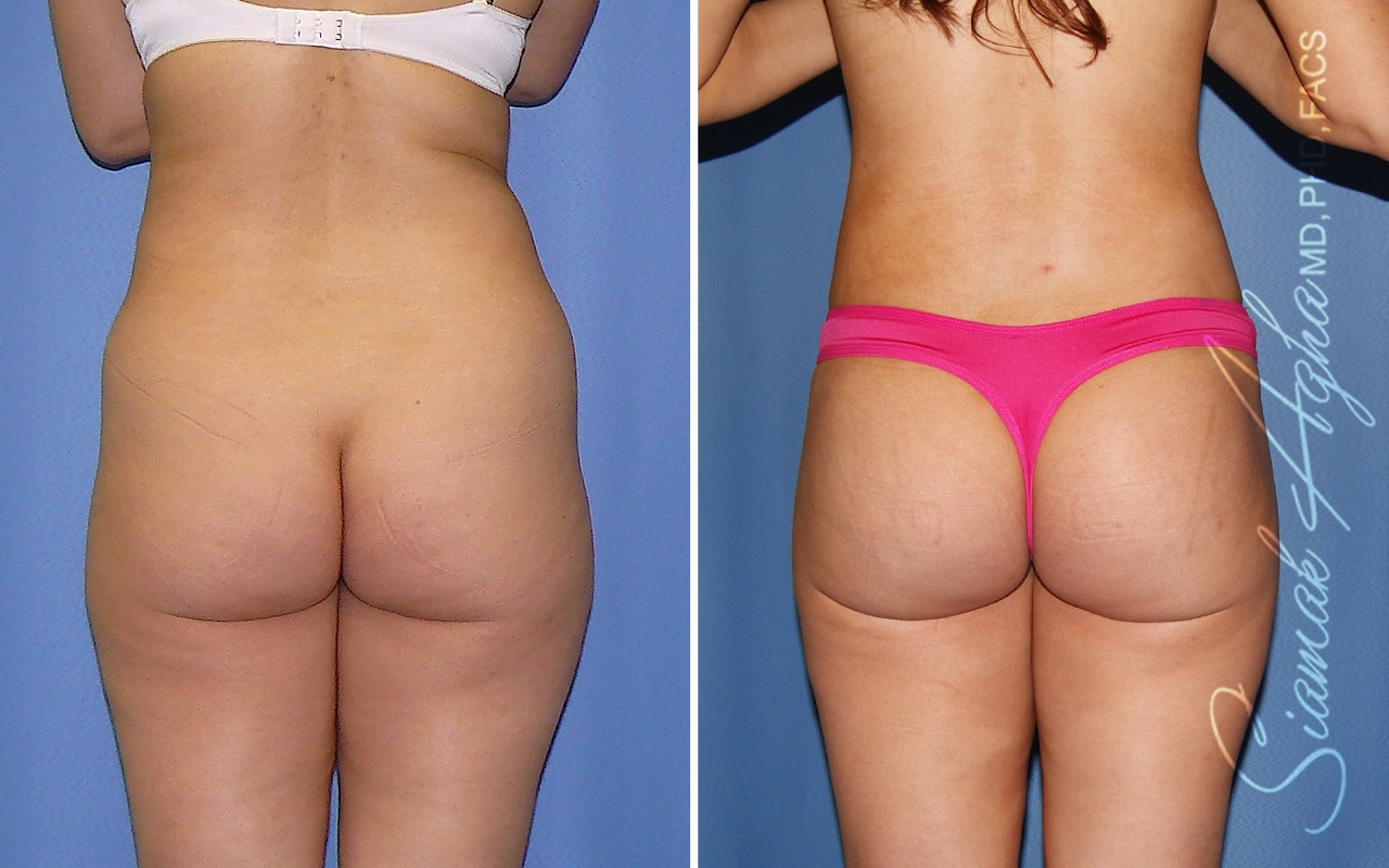 Orange County Brazilian Butt Lift Patient 70 Back Newport Beach, CA