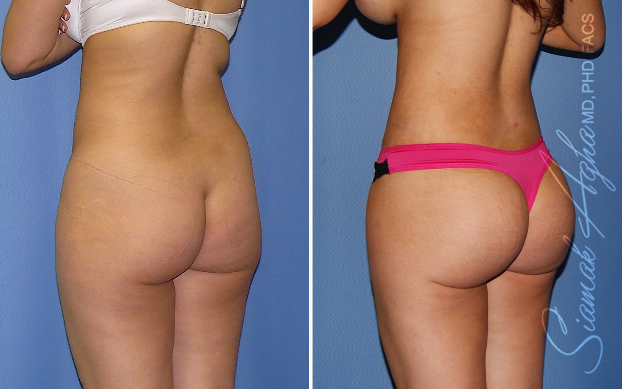 Orange County Brazilian Butt Lift Patient 70 Back Left Newport Beach, CA