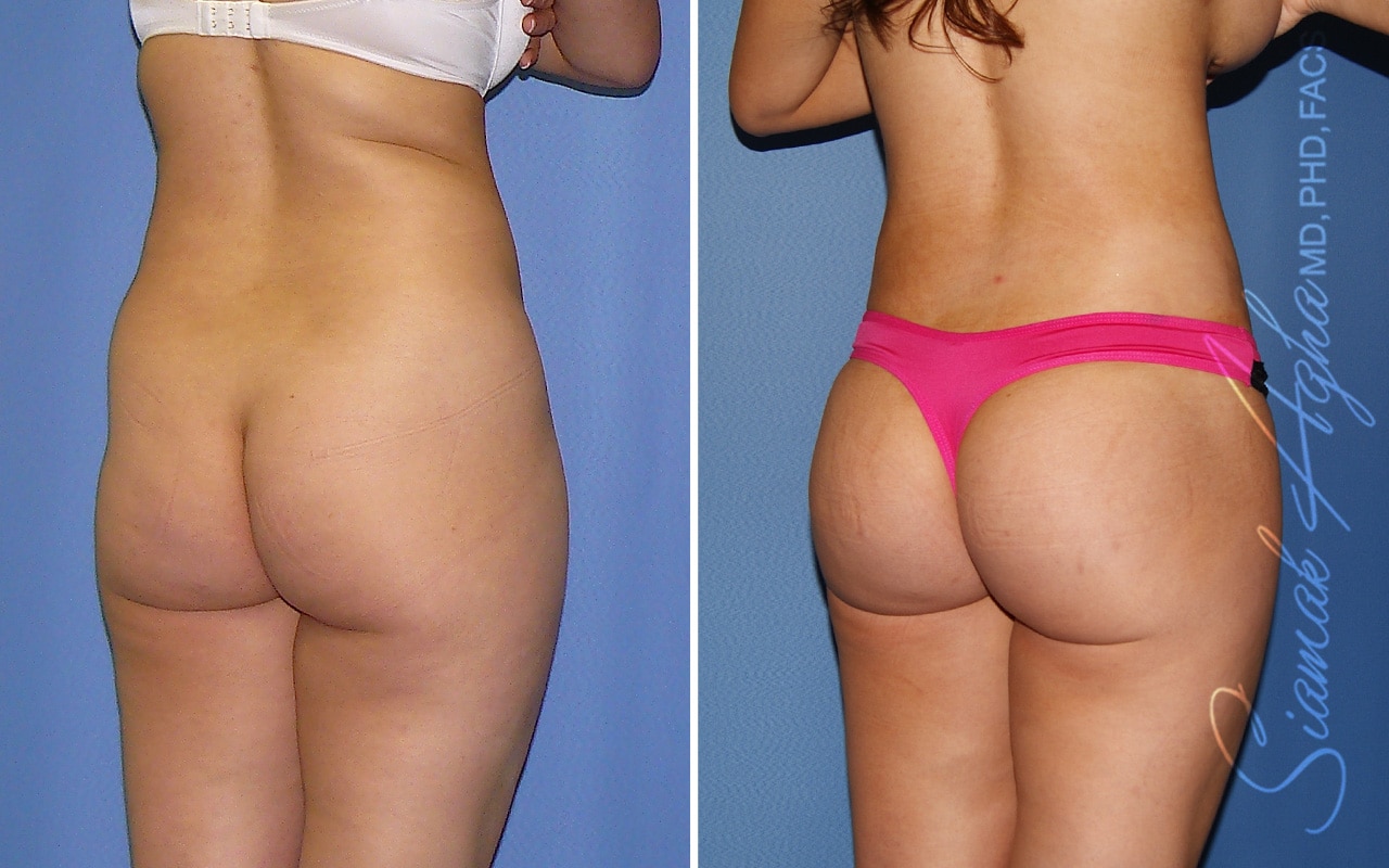 Orange County Brazilian Butt Lift Patient 70 Back Right Newport Beach, CA