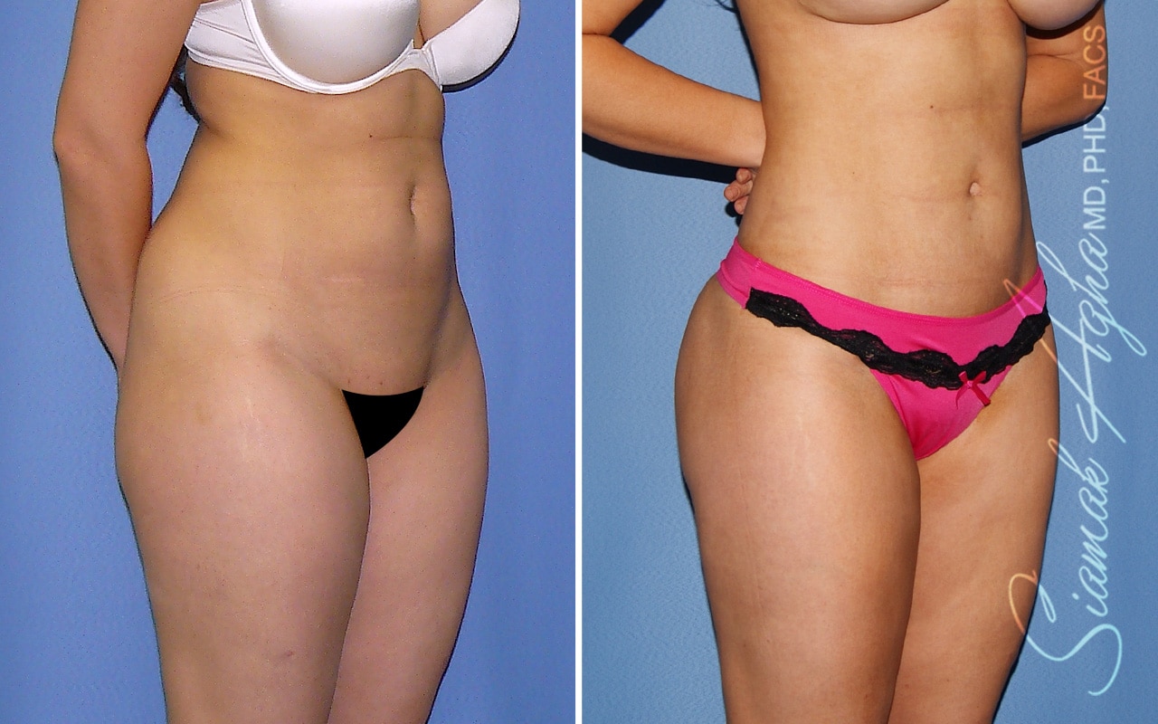 Orange County Brazilian Butt Lift Patient 70 Front Right Newport Beach, CA