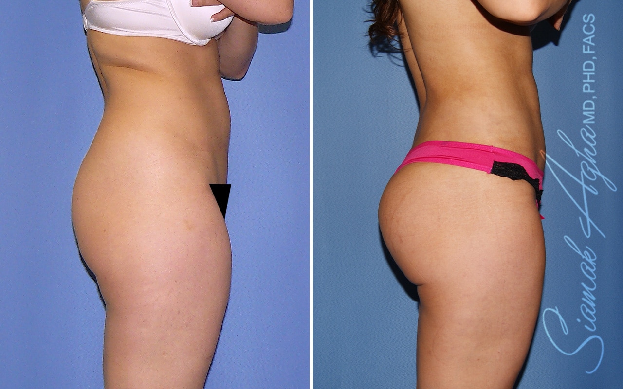 Orange County Brazilian Butt Lift Patient 70 Right Newport Beach, CA