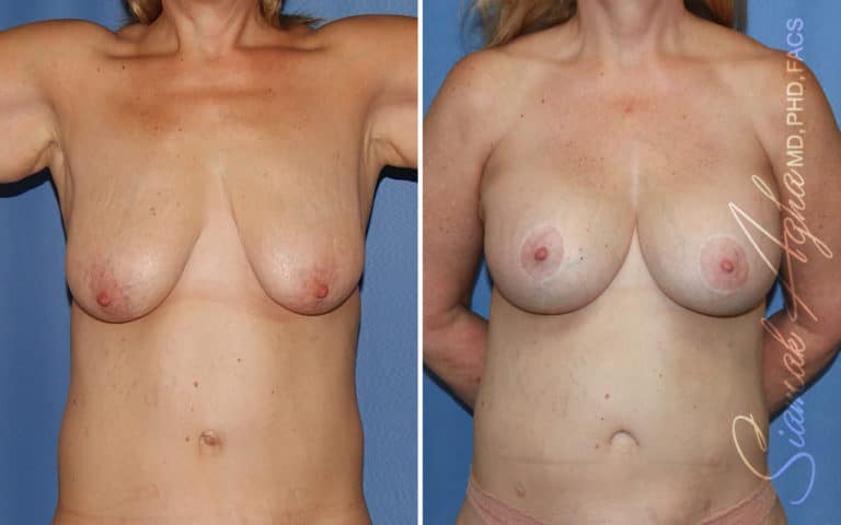 Breast Lift with Augmentation