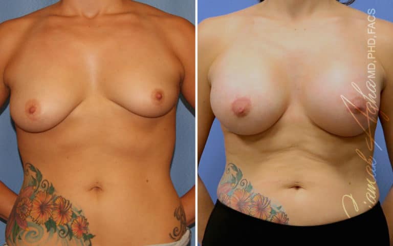 Breast Lift with Augmentation