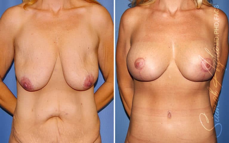 Breast Lift with Augmentation