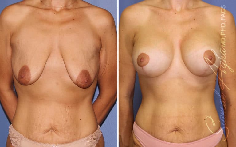 Breast Lift with Augmentation