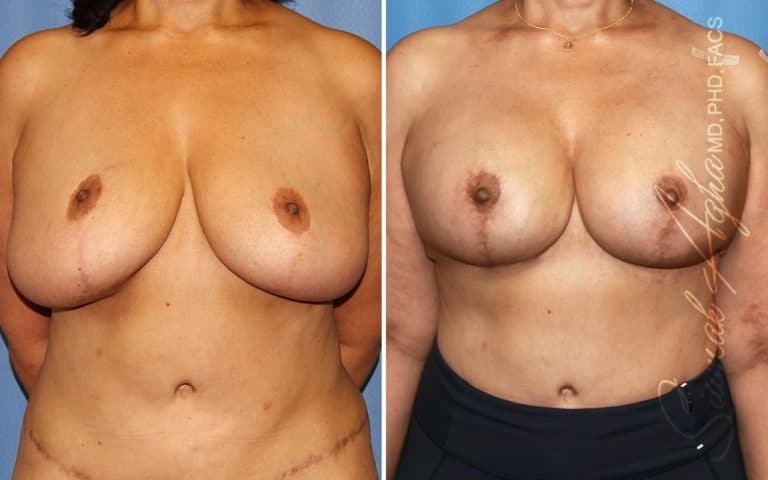 Breast Lift with Augmentation