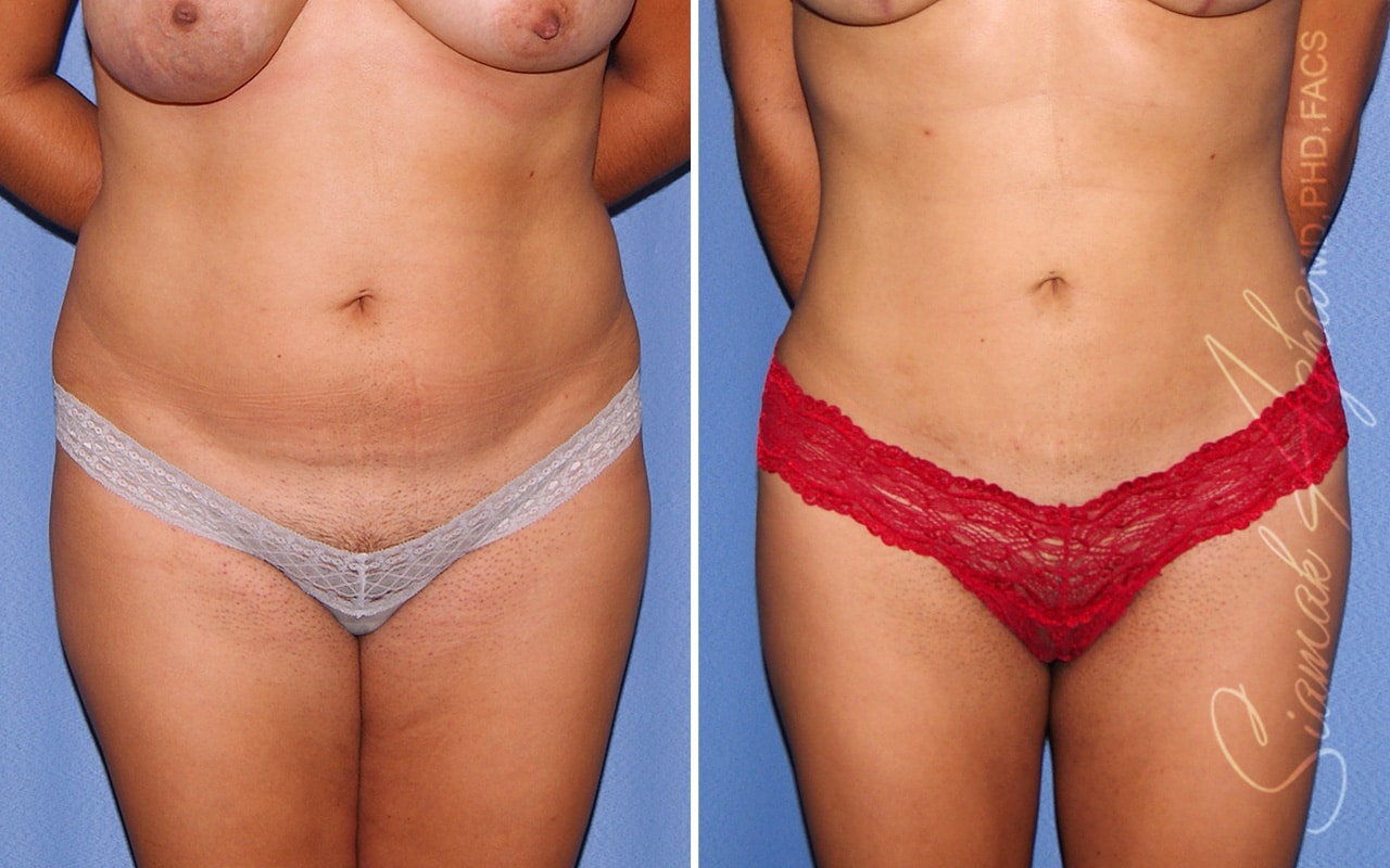 Liposuction