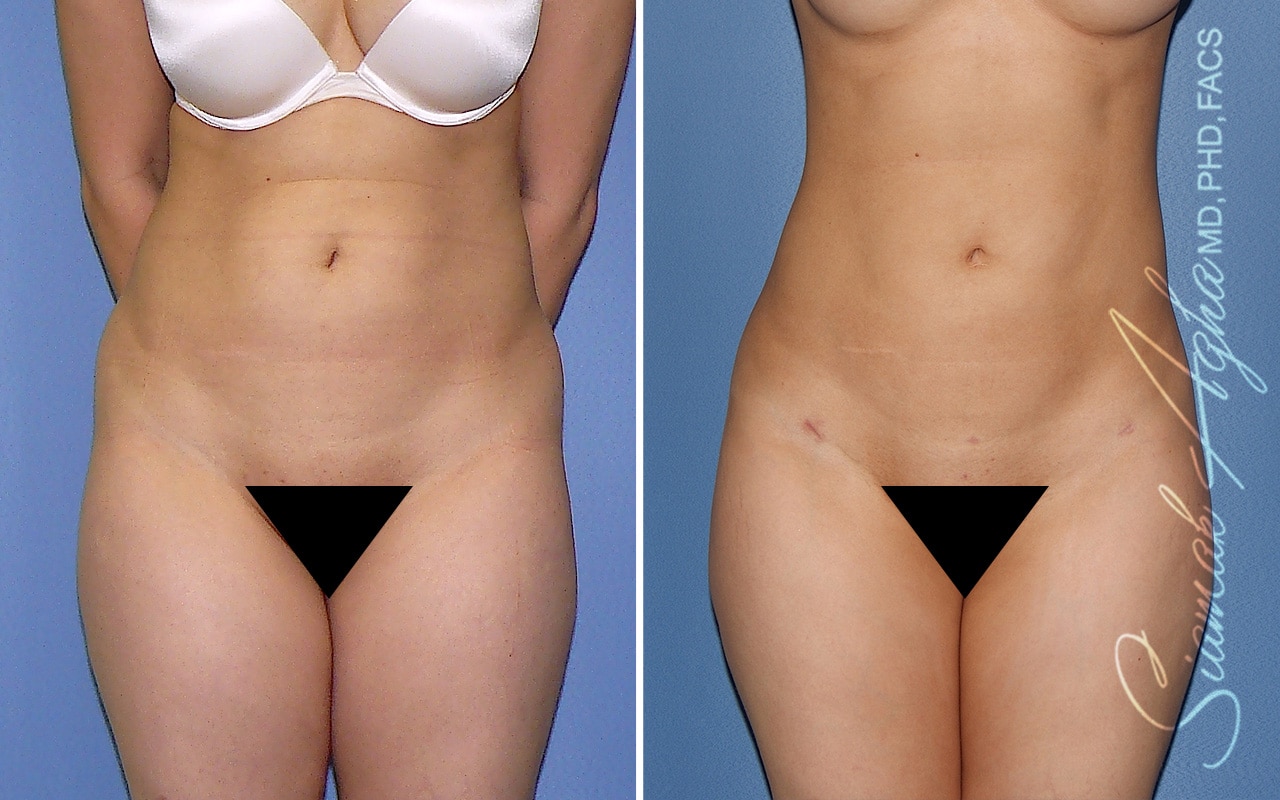 Liposuction