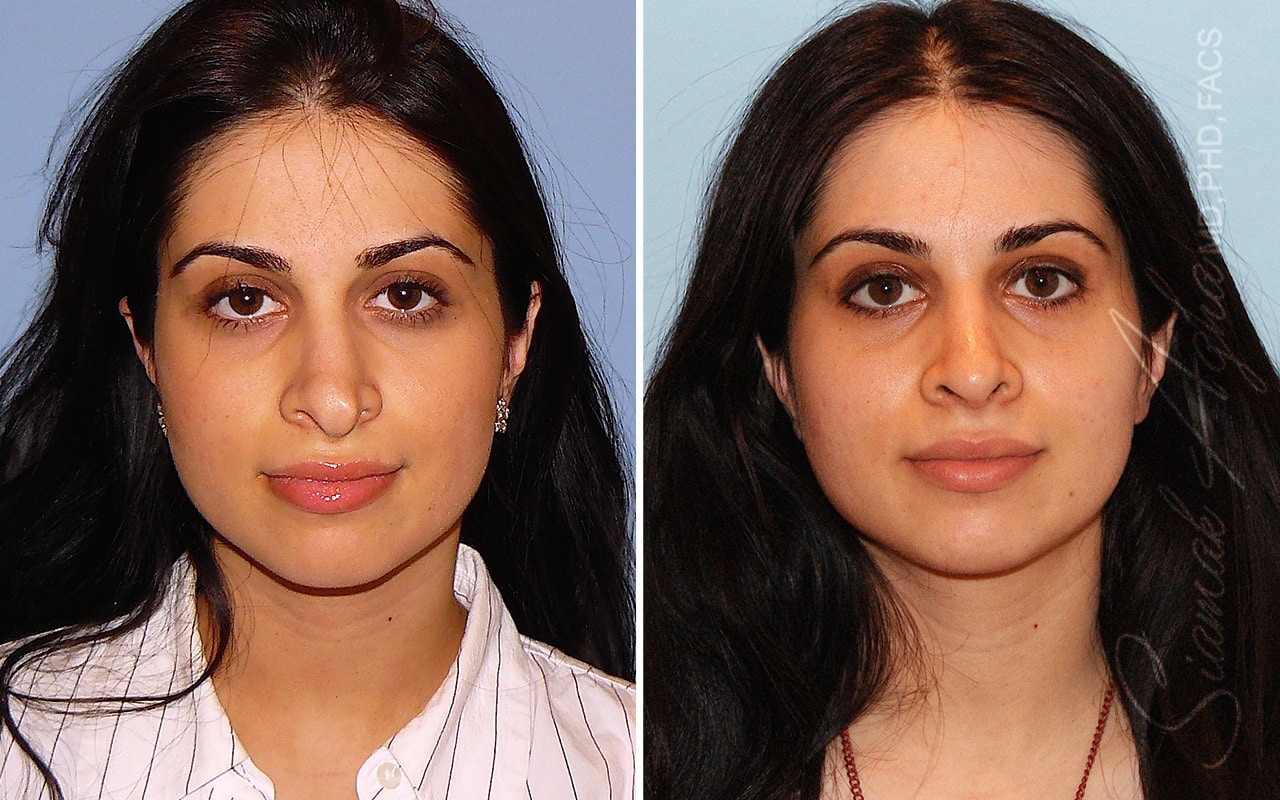 Revision Rhinoplasty