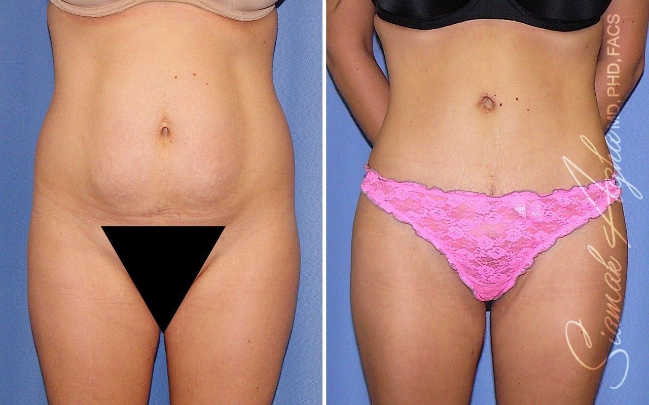 Combined Tummy Tuck and Brazilian Butt Lift