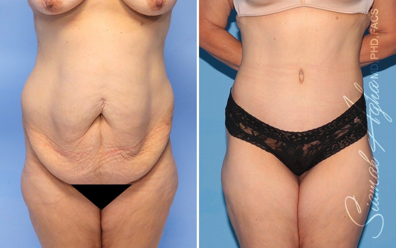 Combined Tummy Tuck and Brazilian Butt Lift