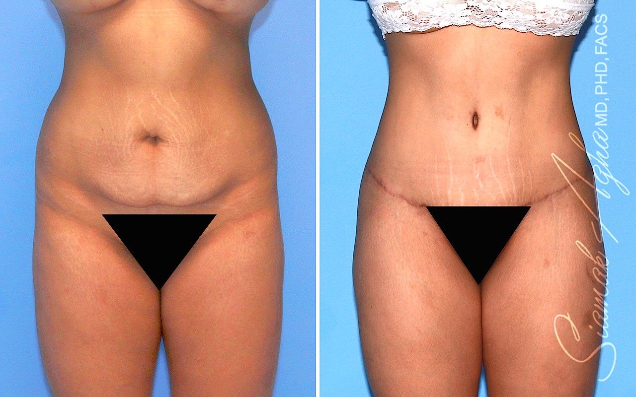 Combined Tummy Tuck and Brazilian Butt Lift