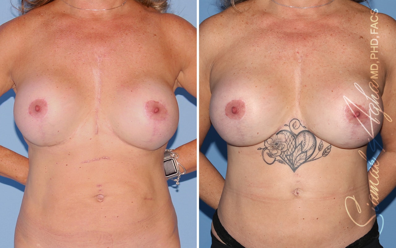 Reverse Tummy Tuck