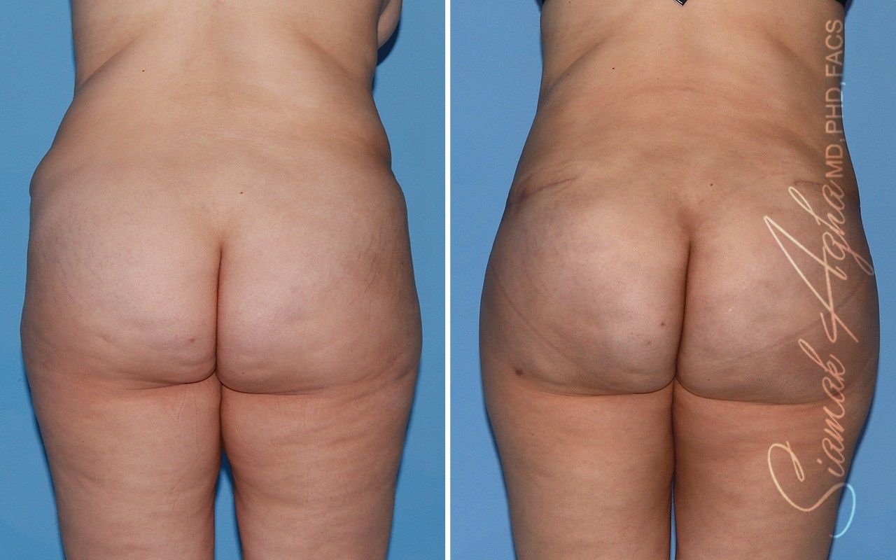 Combined Tummy Tuck and Brazilian Butt Lift