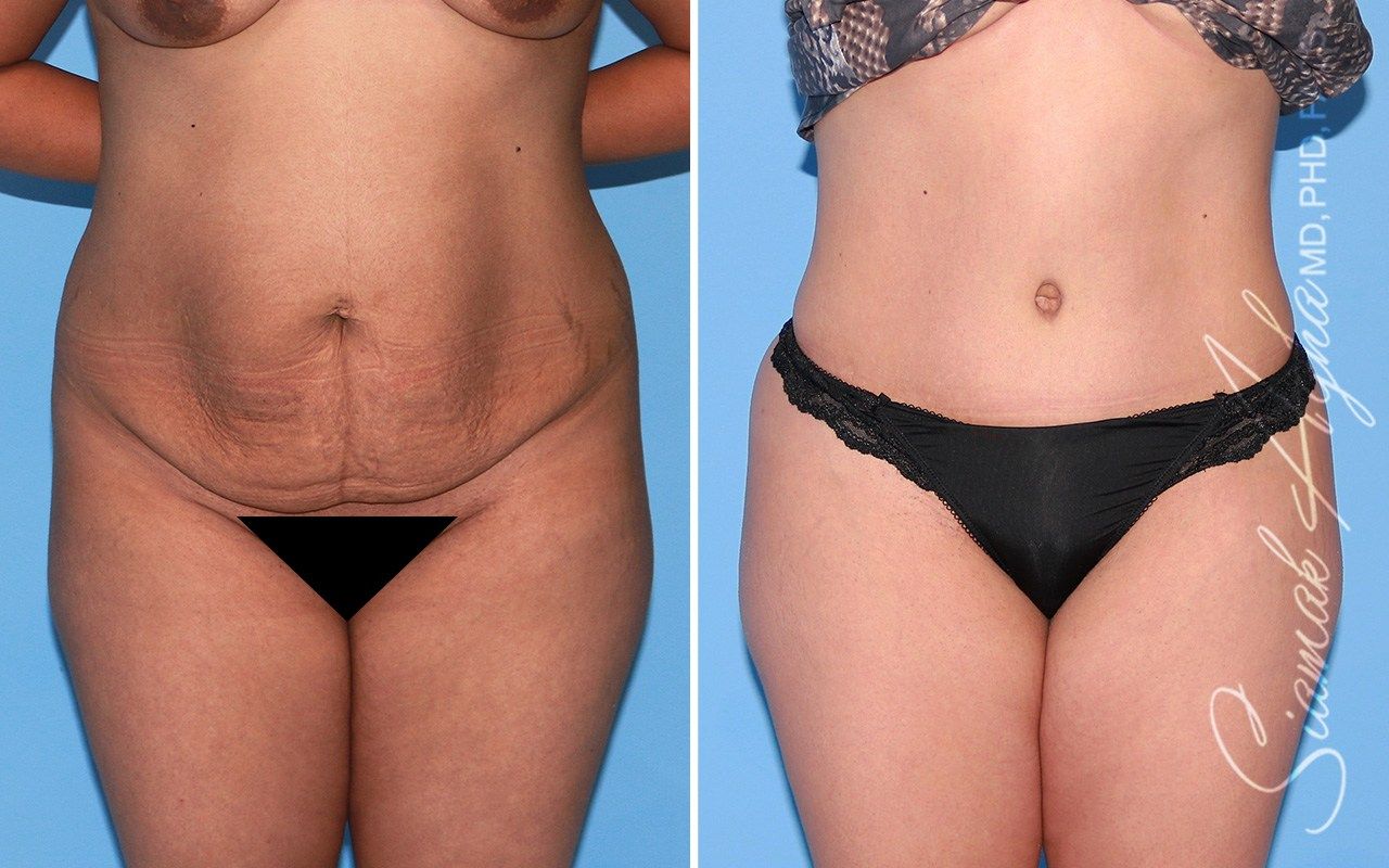 Tummy Tuck