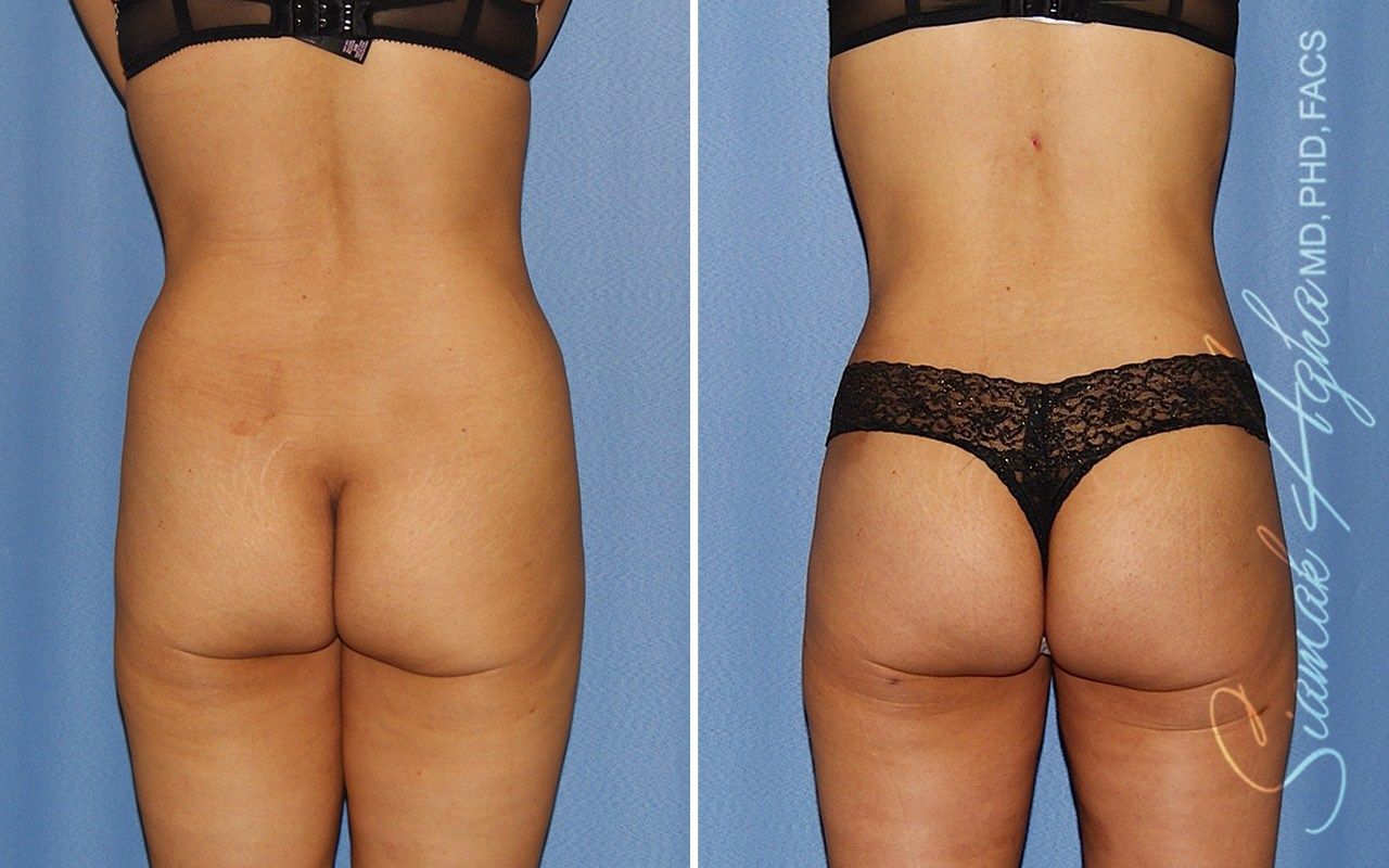 Combined Tummy Tuck and Brazilian Butt Lift