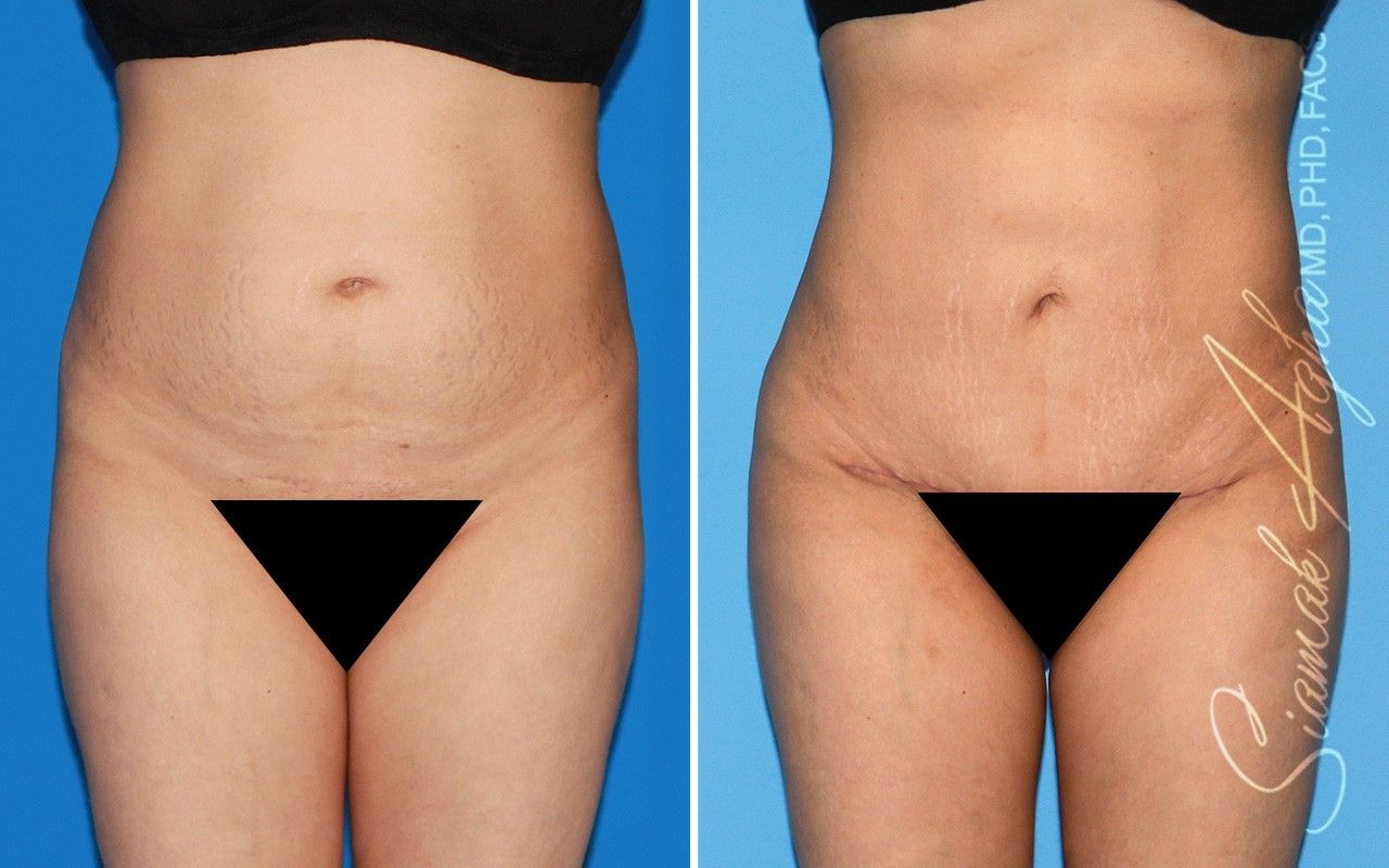 Combined Tummy Tuck and Brazilian Butt Lift