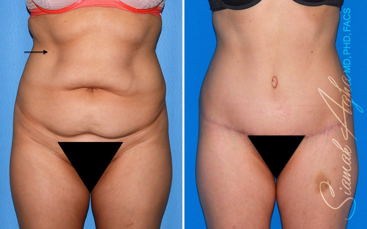 Combined Tummy Tuck and Brazilian Butt Lift