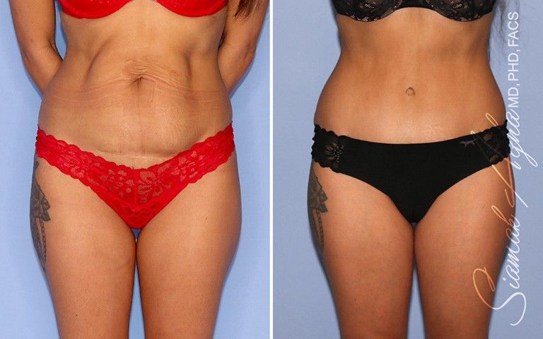 Tummy Tuck