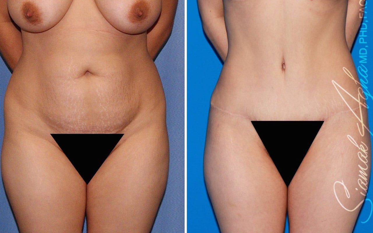 Combined Tummy Tuck and Brazilian Butt Lift