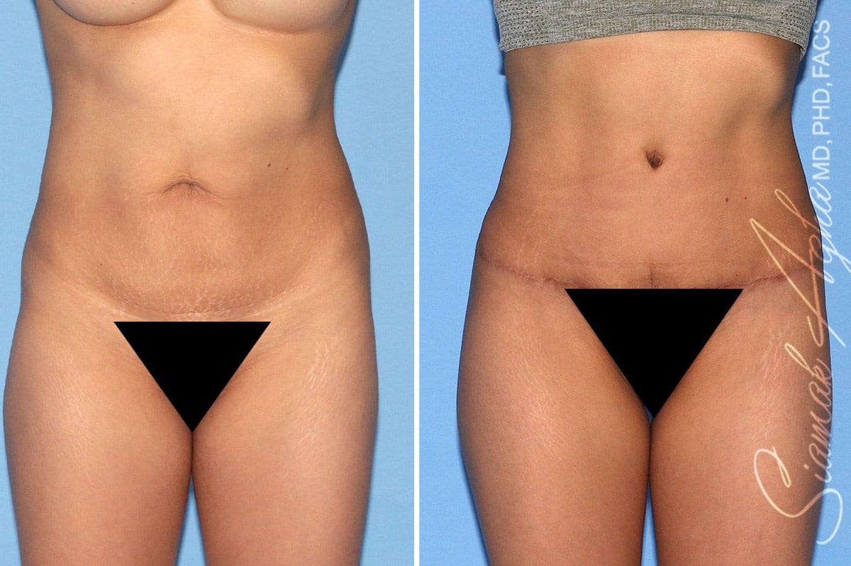 Combined Tummy Tuck and Brazilian Butt Lift