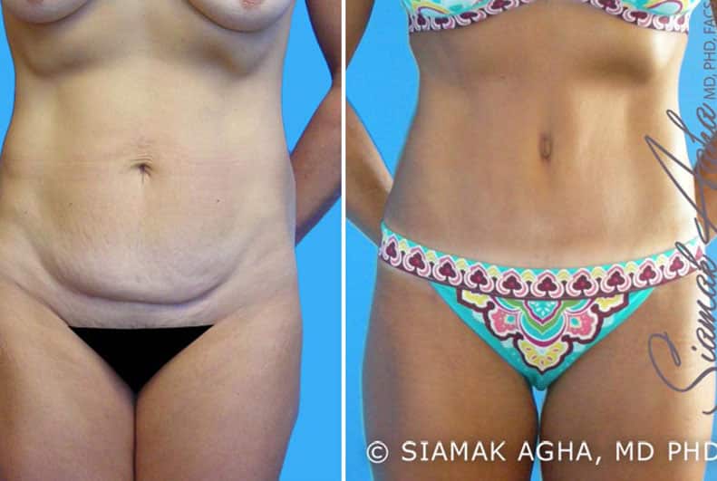 Tummy Tuck